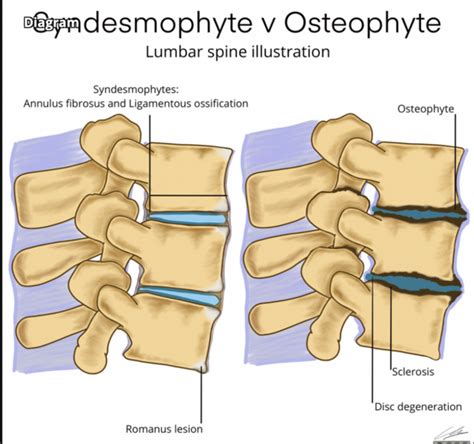 Osteophyte Physiopedia