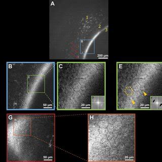 In Vivo Human Corneal Images Of Mid And Posterior Stroma Obtained With