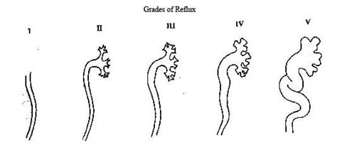 Vesicoureteral Reflux Vur