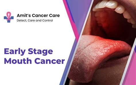 The Early Stage of Cheek Mouth Cancer | Symptoms & Treatments