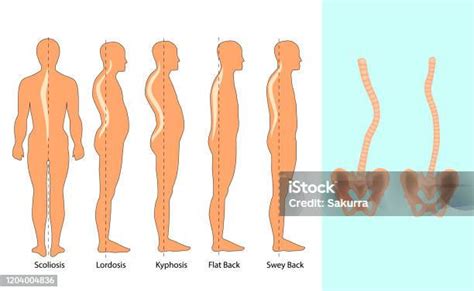 Ilustrasi Vektor Jenis Kelainan Bentuk Tulang Belakang Skoliosis