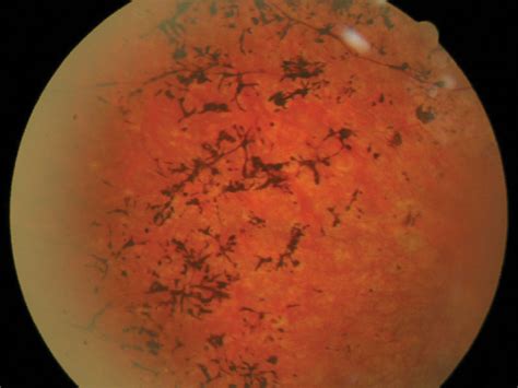 Retinitis Pigmentosa Al Manal Eye Hospital