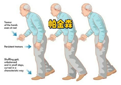 Jpd：帕金森患者，自我报告的视力问题，可严重影响生活质量 Medscicn