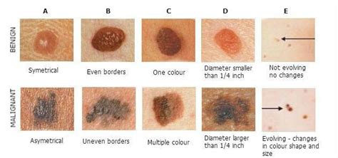 Moles Raised Lesions Nu Image Medical Esthetics