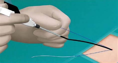 Disposable Vascular Closure Device – Weiyuan Medical Device