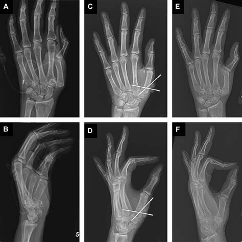 Management Of Acute And Chronic Thumb Cmc Joint Dislocations Hand Clinics