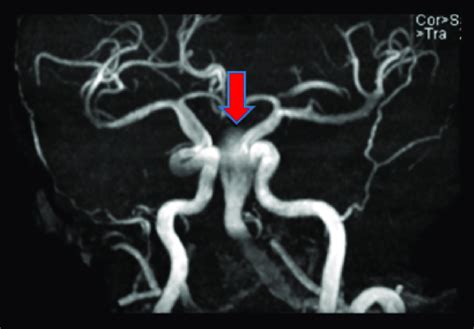 Case 1 Head And Neck Magnetic Resonance Angiography Mra Head And