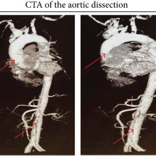 Echocardiography And Computed Tomography Angiography Findings For