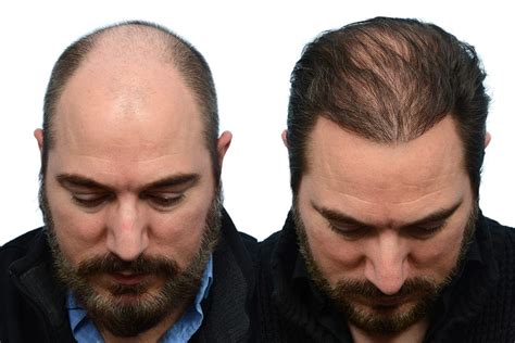 Patient 103523 Fue Hair Transplant Before And After Photos Dr Wise