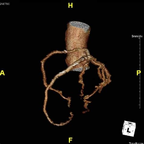 Ct Coronary Angiography 3d Reconstruction Of Coronary Vessels