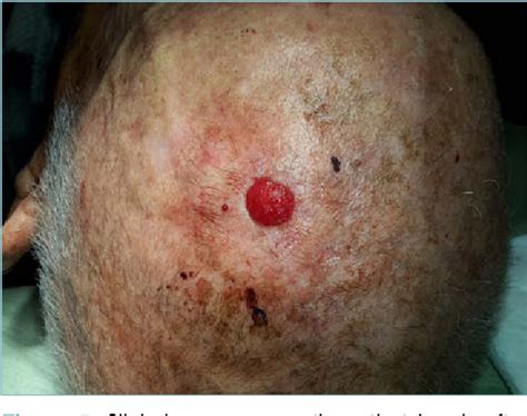 Pdf Atypical Fibroxanthomapleomorphic Dermal Sarcoma Of The Scalp