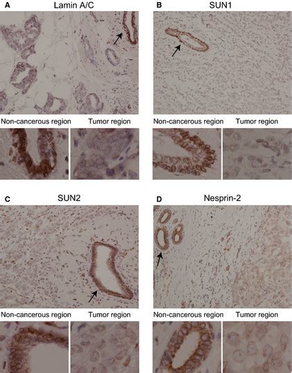 Loss Of Lamin A C SUN1 SUN2 And Nesprin 2 Staining In The Cancerous