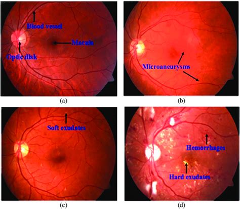 A Retinas Anatomical B Mild C Moderate And D Severe