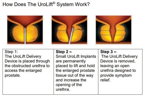 Urolift® System For Bph South Valley Urology