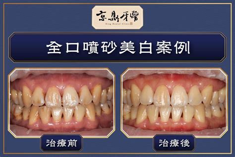 8種牙齒美白方法及費用全指南，一篇解析適合自己的美白方式 京鼎牙醫