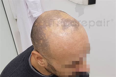 Come Intervenire Sull Alopecia Cicatriziale Del Lichen Plano Pilare