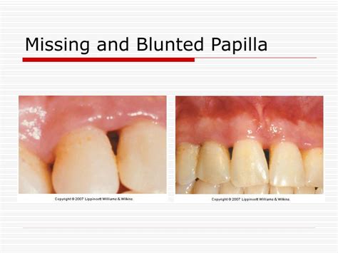 Difference between flat and blunted affect - luaartists