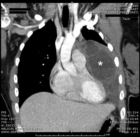 Hemorrhagic Pericardial Cyst Diagnosis Accelerated By Emergency