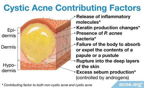 Regular Acne Vs. Cystic Acne: What's the Difference? - Acne.org