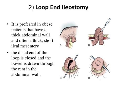 Cutaneous Urinary Stoma