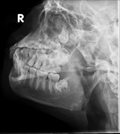 Mandible Axiolateral Oblique View Radiology Reference Article