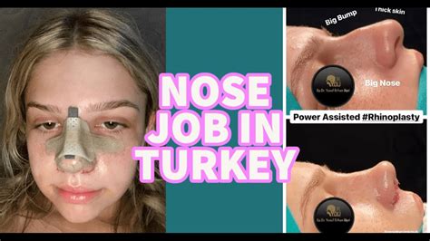 I GOT A NOSE JOB IN TURKEY YouTube