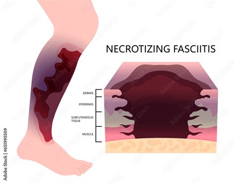 Leg injury with skin infection of Necrotizing fasciitis cause limb pain ...