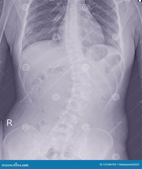 Curva Espinal De La Demostraci N De La Radiograf A De La Pel Cula En
