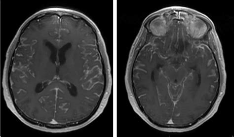 Frontiers Challenges And Advances In Diagnosis And Treatment Of