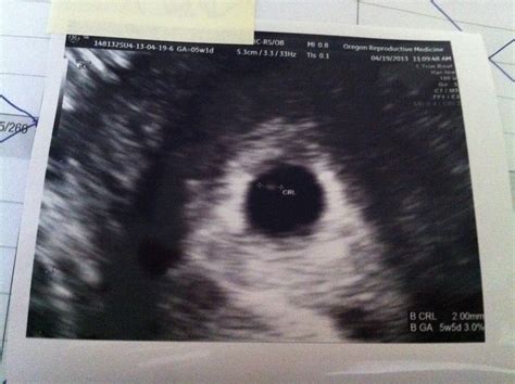 Ready For My Turn 5w1d Ultrasound Report