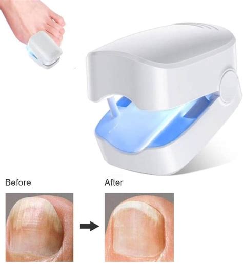 Tratamiento Con Láser Para Hongos En Las Uñas Dispositivo Láser