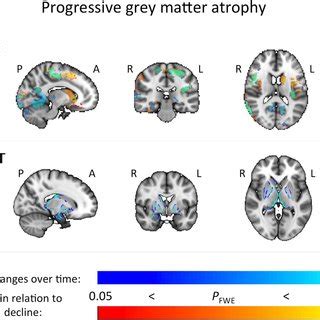 Progressive Grey Matter Decline Over Time Blue Overlaid