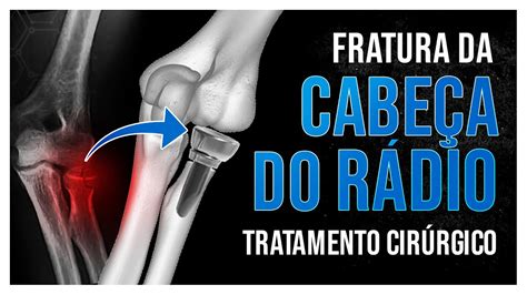 Fratura Da Cabe A Do R Dio Como O Tratamento Cirurgia Youtube