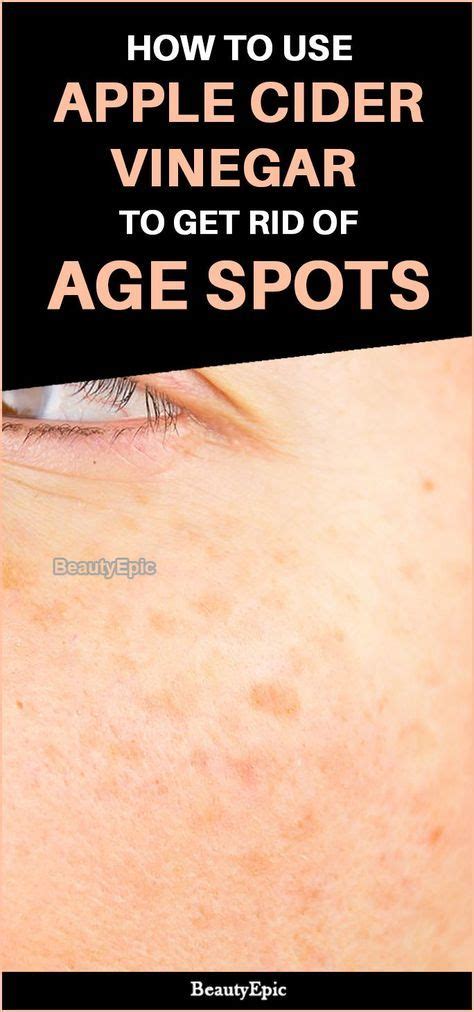 How To Treat Age Spots With Apple Cider Vinegar Age Spots On Face How To Get Rid Of Acne