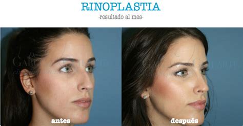 ¿rinoplastia Abierta O Cerrada OperaciÓn Nariz