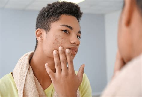 Exploring Effective Acne Treatments For Teenagers