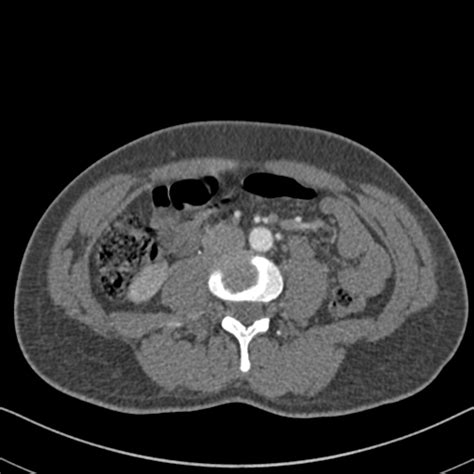 File Marfan Syndrome With Ascending Aortic Aneurysm And Stanford A