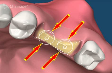 Bone Grafting Dental Implants Archway Oral Surgery Dental Implants