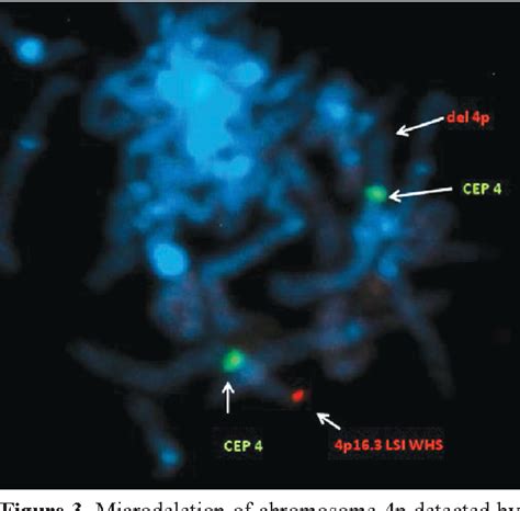 Figure 3 From Phenotypic Variations In Wolf Hirschhorn Syndrome