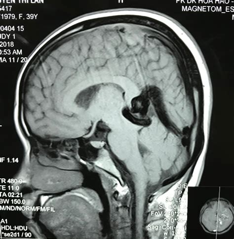 VIETNAMESE MEDIC ULTRASOUND: CASE 487: BRAIN AVM, Dr PHAN THANH HẢI