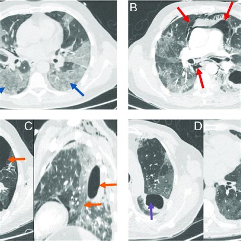 A Chest Ct Showing Bilateral Ground Glass Opacities Blue Arrow On Download Scientific