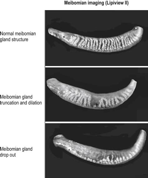 Meibomian Gland Dysfunction and Evaporative Dry Eye - Clinical Tree