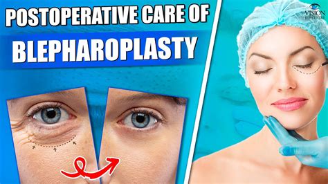 Postoperative Care Of Blepharoplasty Dr Rwituja Th Grover Vision