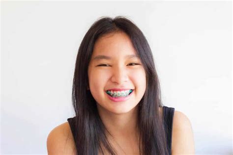 Conventional Braces Treatment KL & Selangor | Smile Beauty