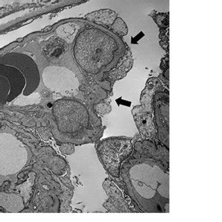 Electron Microscopic Examination Of Glomerulus Reveals Widespread