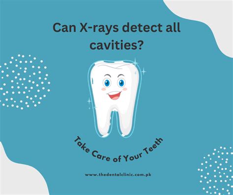 Can X-rays detect all cavities? The Ultimate Guide To Dental Imaging ...