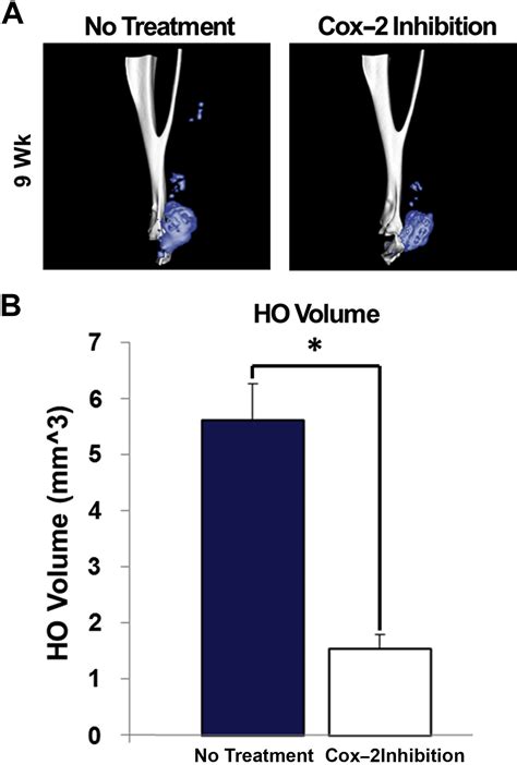 Heterotopic Ossification Following Upper Extremity Injury Hand Clinics