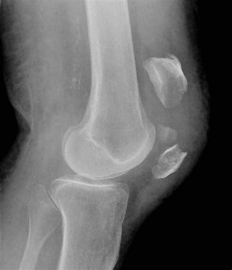 Patella Fracture - Wiki Sports Medicine : r/orthopaedics