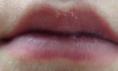 Healthoolwhite spots on lips | Healthool