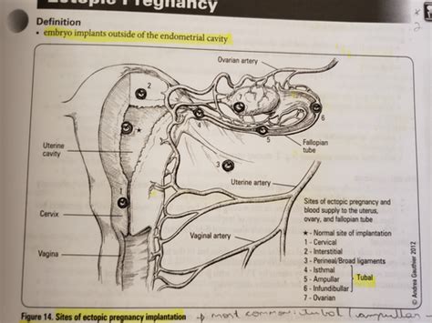 Ectopic Pregnancy Flashcards Quizlet